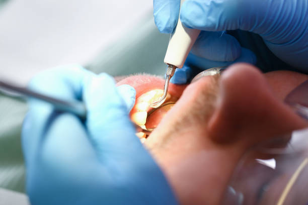Best Emergency Root Canal Treatment in Biltmore Forest, NC