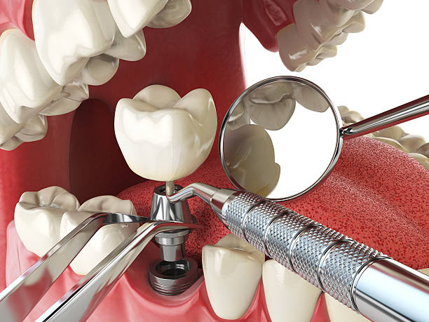 Best Emergency Dental Extractions in Biltmore Forest, NC